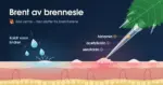 Illustrasjon av et forstørret brennhår fra et brennesleblad som stikker inn i et tverrsnitt av huden og sprøyter inn histamin, acetylkolin og serotonin, slik at det dannes lyse kuler med rødme rundt, mens kalde vanndråper lindrer huden ved siden av, med teksten «Brent av brennesle».